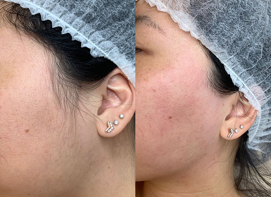 Before and after procedure